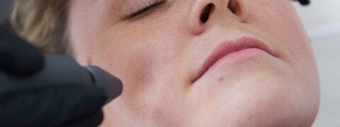 Cryotherapy Facial