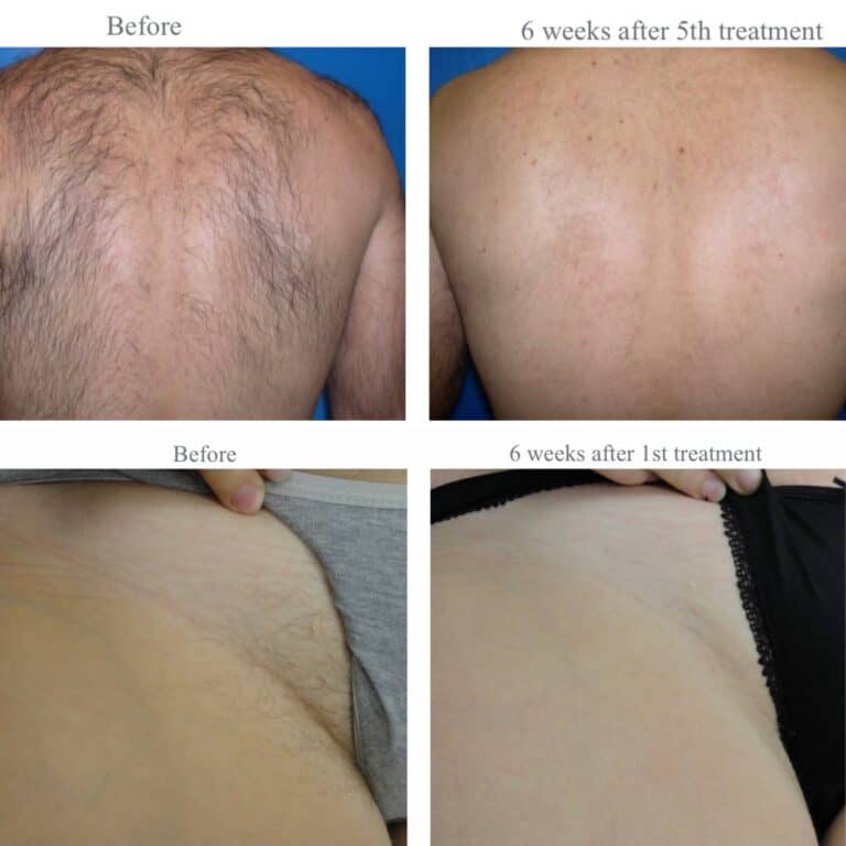 Laser hair removal before and after results at Aqua-Tox, Hertford