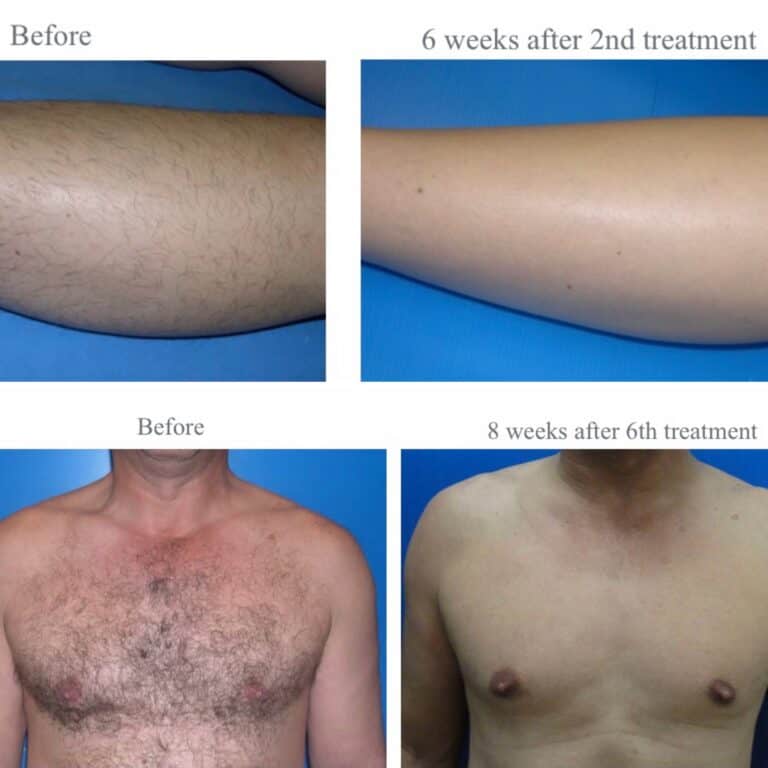 Laser hair removal before and after treatment with Soprano Titanium