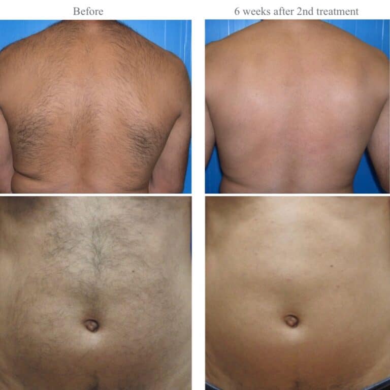 Laser hair removal results on a male chest and back at Aqua-Tox, Hertford