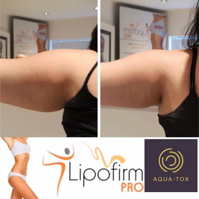 Lipofirm Bingo Wing Buster upper arm before and after