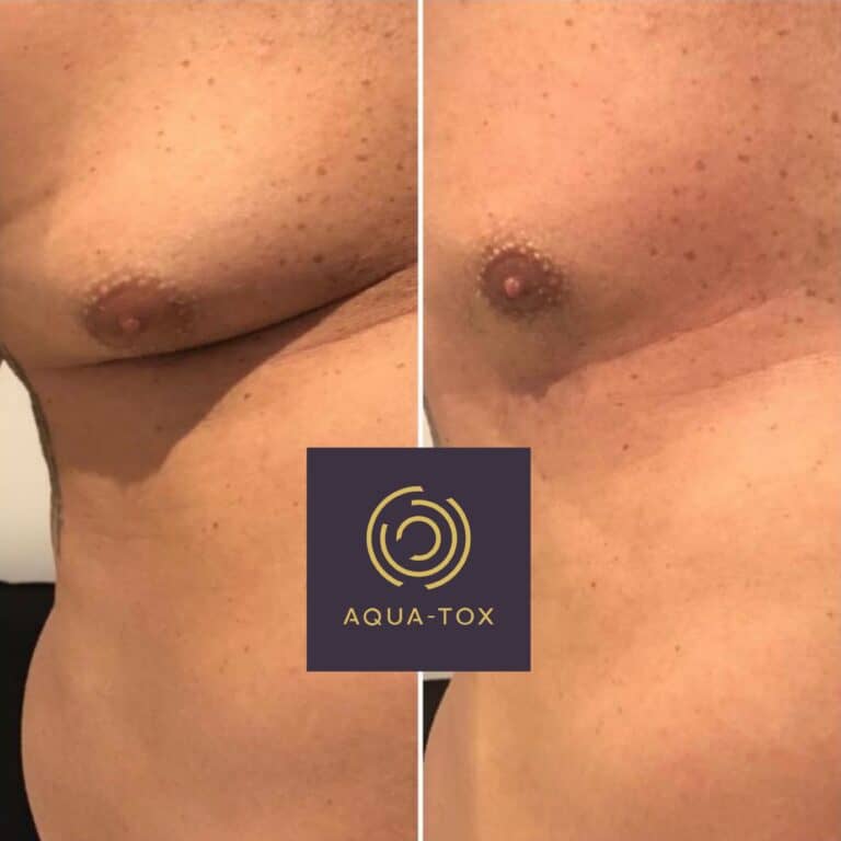 Lipofirm bra bulge before and after