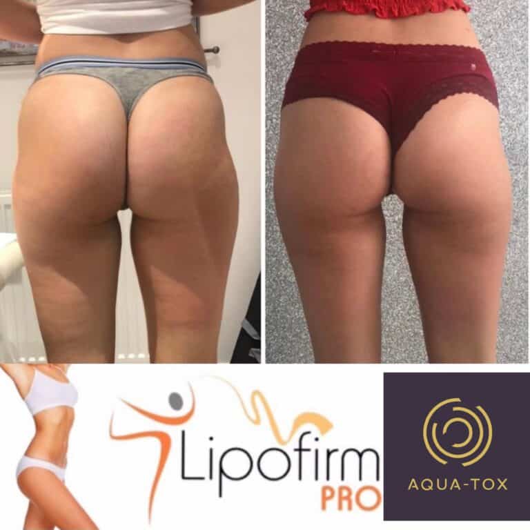 Lipofirm butt lift before and after