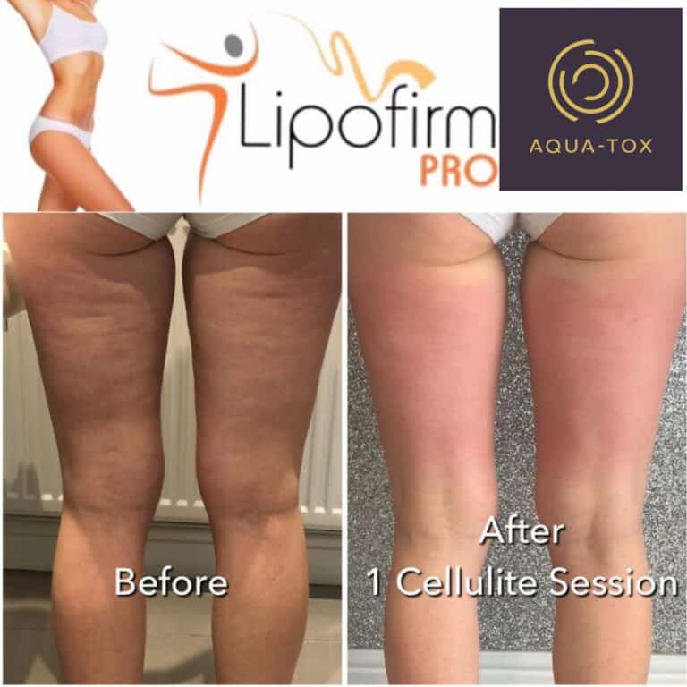 Lipofirm thigh cellulite before and after