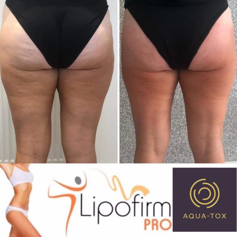 Lipofirm cellulite reduction before and after