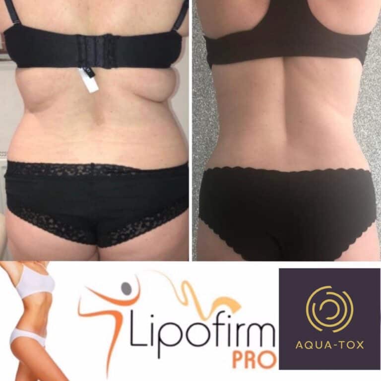 Lipofirm love handles before and after