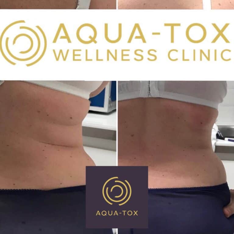 Lipofirm love handles treatment before and after