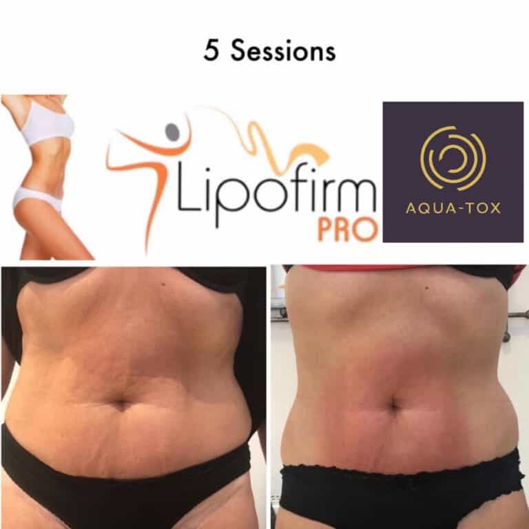Lipofirm non surgical tummy tuck before and after