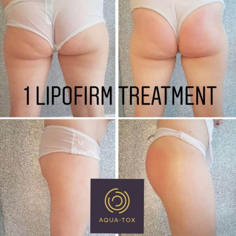 Lipofirm Pro butt lift before and after