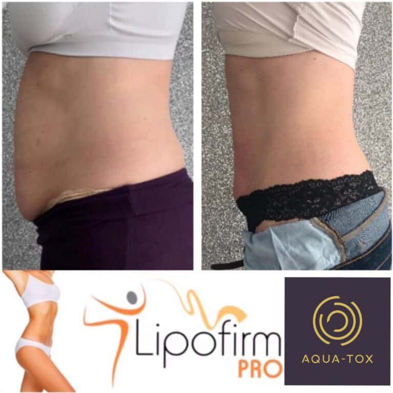 Lipofirm Pro non surgical fat reduction before and after