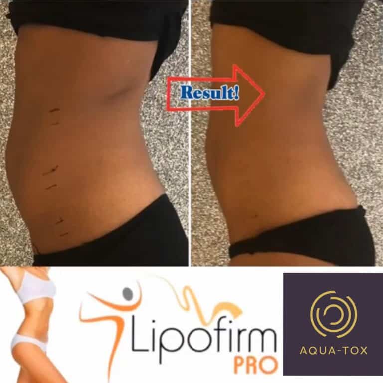 Lipofirm Pro non surgical tummy tuck before and after