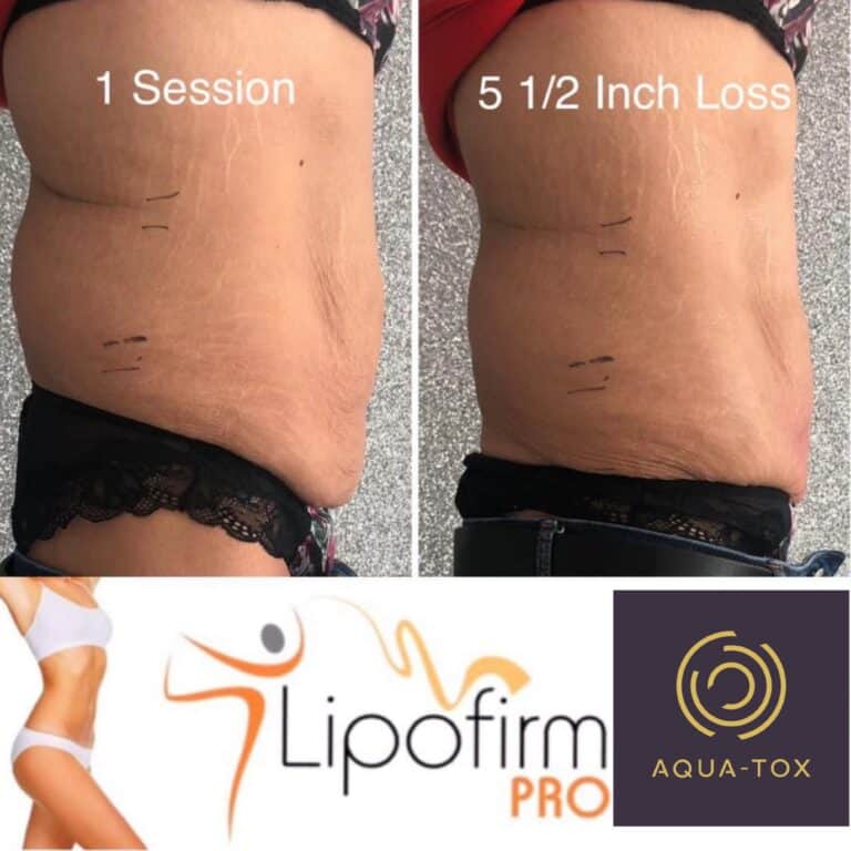 Lipofirm Pro non surgical tummy tuck results