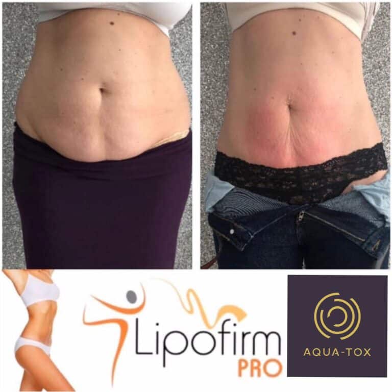 Lipofirm Pro tummy tuck results