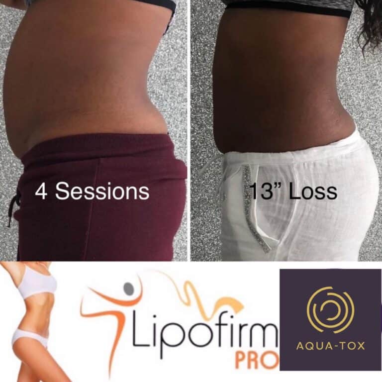 Lipofirm Pro tummy tightening before and after
