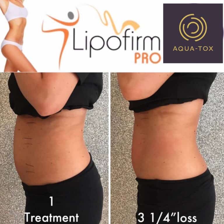 Lipofirm Pro tummy tuck results after a course