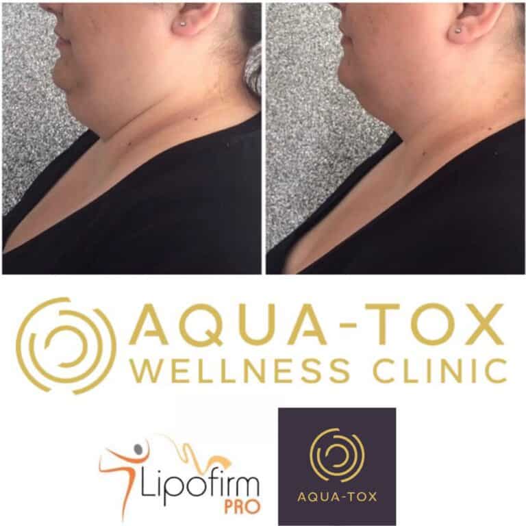 Lipofirm Pyramid facial before and after