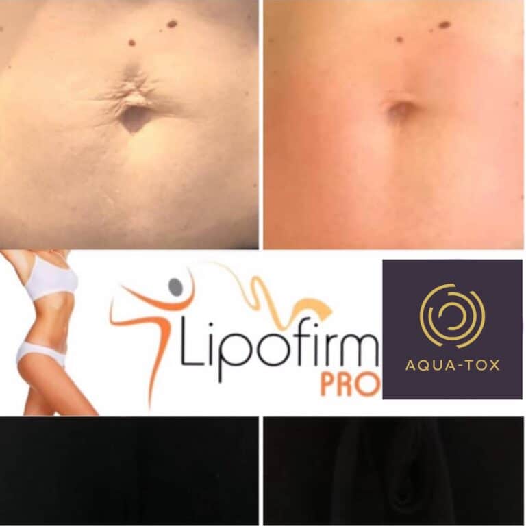 Lipofirm tummy contouring before and after