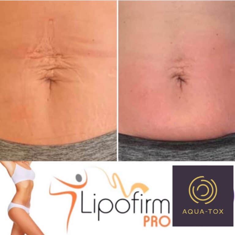 Lipofirm tummy contour results