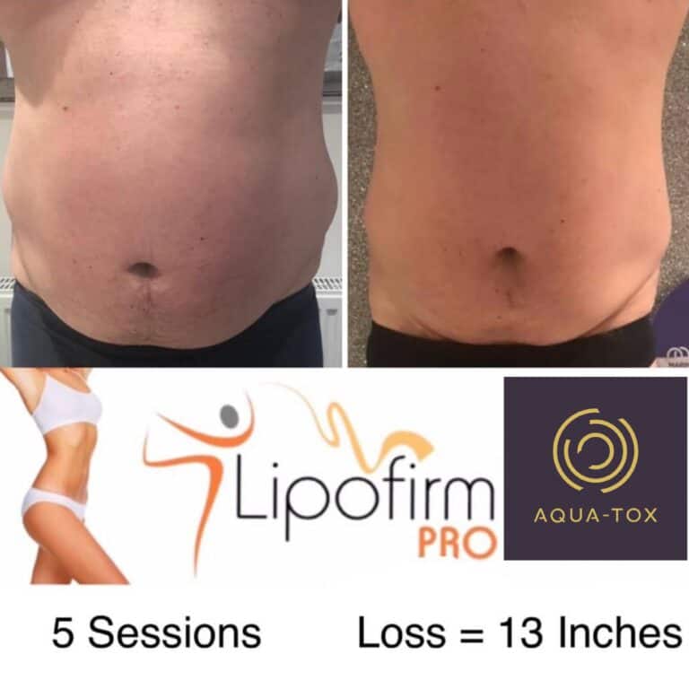 Lipofirm tummy tuck before and after at Aqua-Tox, Hertford