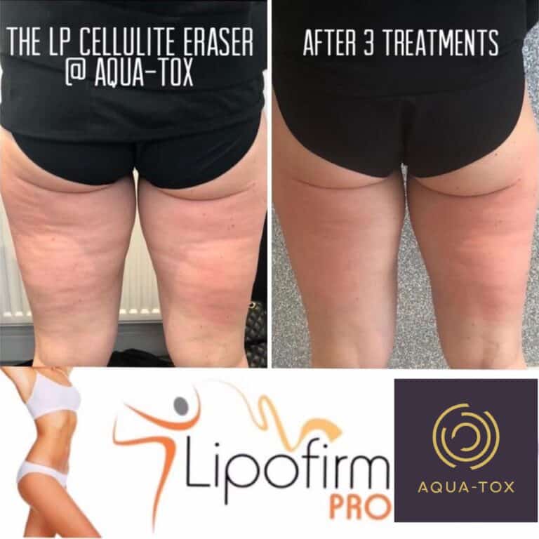 Non surgical cellulite reduction before and after