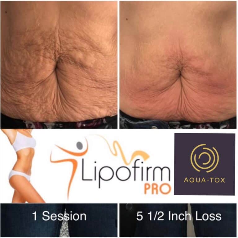 Lipofirm Pro tummy tuck before and after
