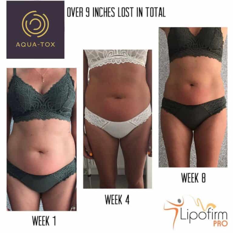 Non surgical tummy tuck before and after at Aqua-Tox, Hertford