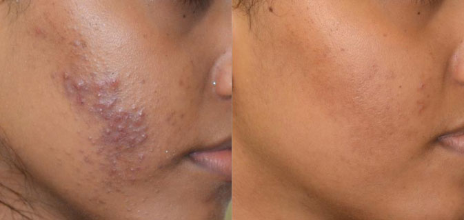 Acne Laser Skin Treatment Before and After