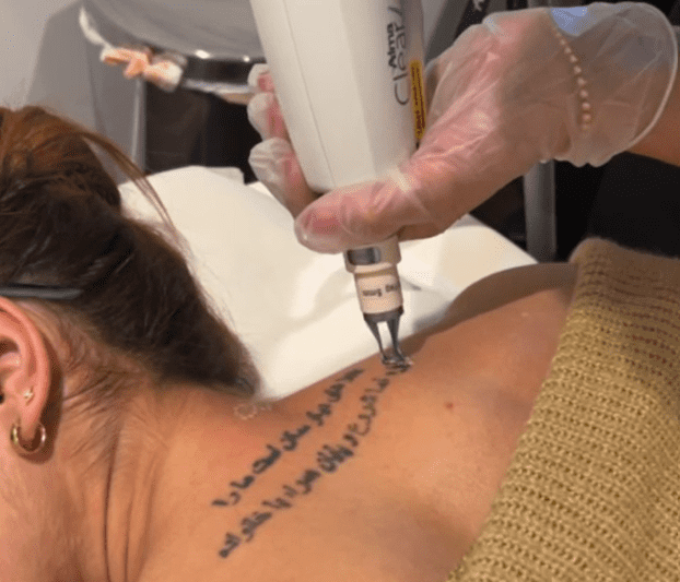 laser tattoo removal process - laser is over a tattoo on the back