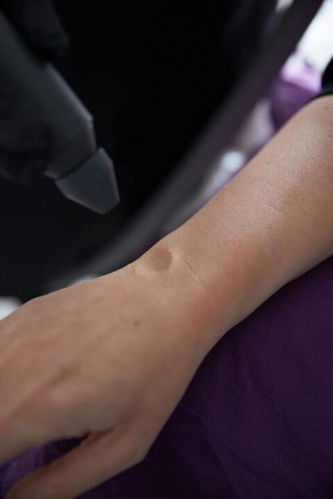 local cryotherapy treatment on a wrist injury