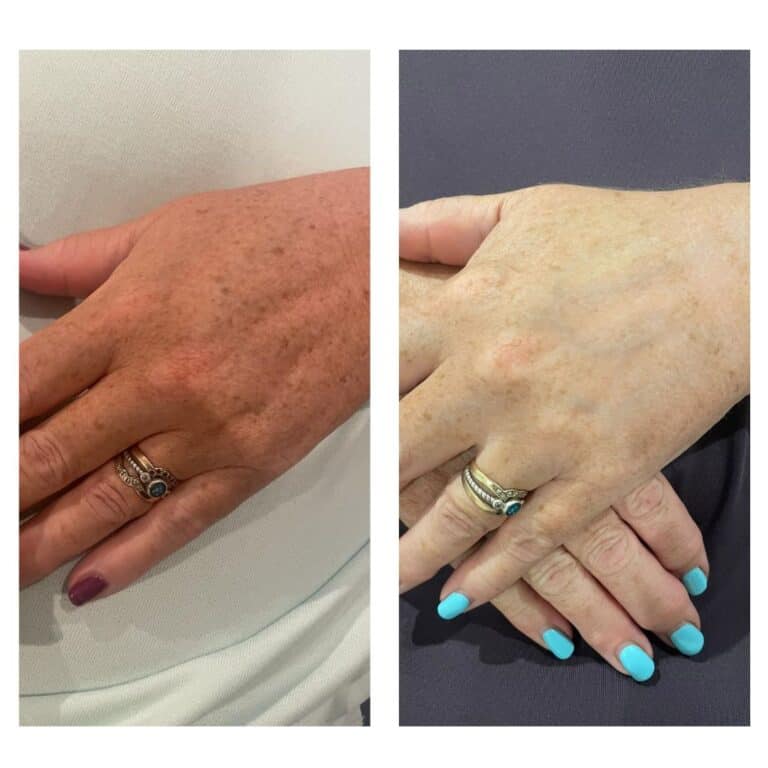 Before and after a ClearLift hand treatment, with fewer age spots and less pigmentation