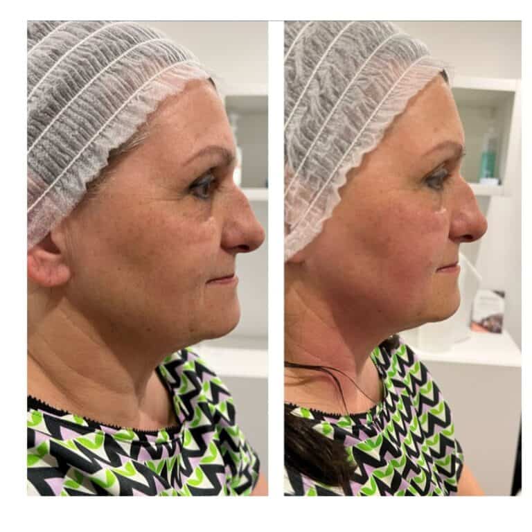 Before and straight after a full face ClearLift treatment with near infrared skin tightening