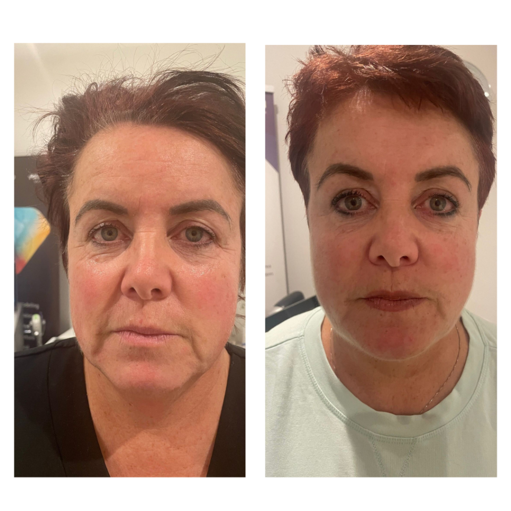 A female face is shown twice side by side to demonstrate the results of Clear Lift laser treatment. Her skin looks brighter and plumper in the second photo with a visible reduction in nose to mouth lines.