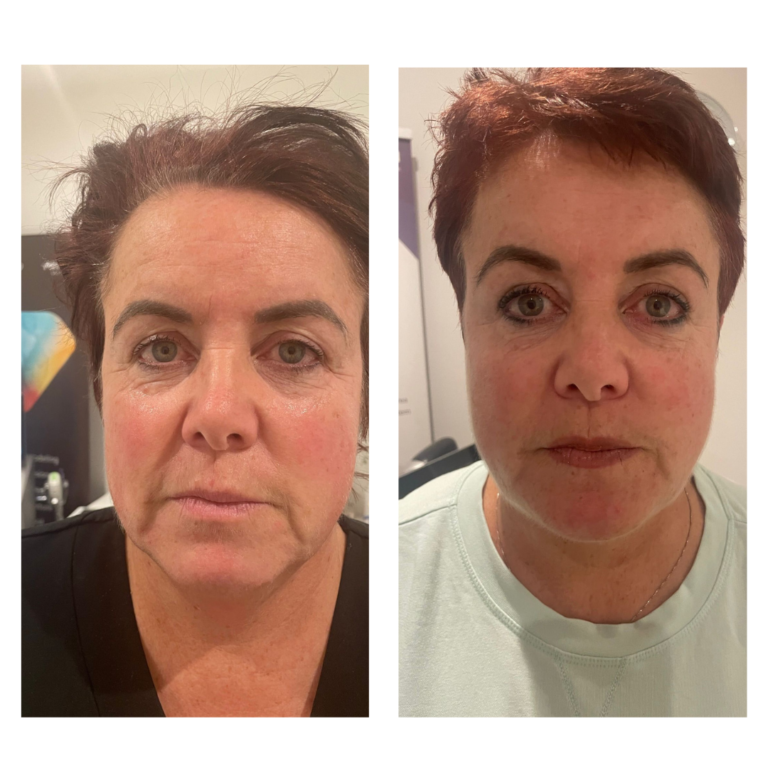 Before and after two ClearLift full face treatments, with brighter, plumper skin and softer nose to mouth lines