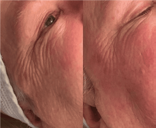 a close up view of a female face eye area before and after a geneo radio frequency facial, lines around the eyes are greatly reduced and the skin looks brighter
