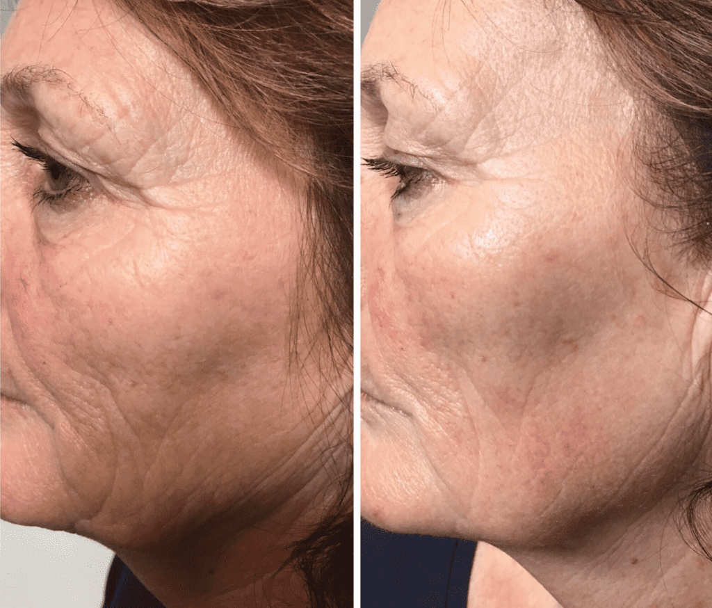 a side view of a female face before and after a geneo radio frequency facial, a visible reduction in wrinkles can be seen around the mouth and eyes and the skin appears younger and brighter