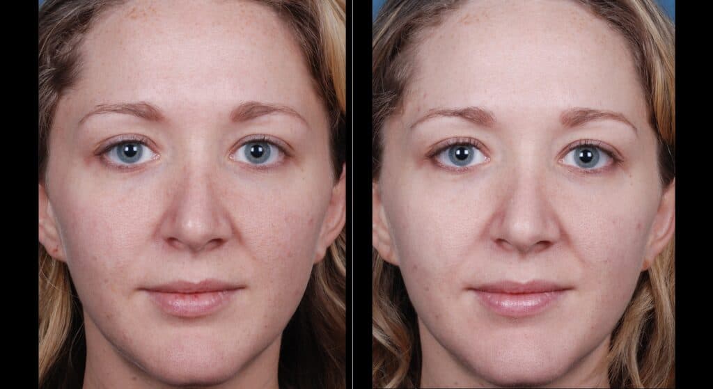 a before and after image of a female face after having 3 blue peel radiance skin peels at 2 week intervals, skin looks improved