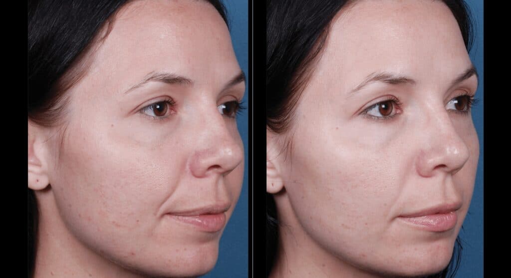 a before and after image of a female face after having 3 blue peel radiance skin peels at 2 week intervals, skin looks improved