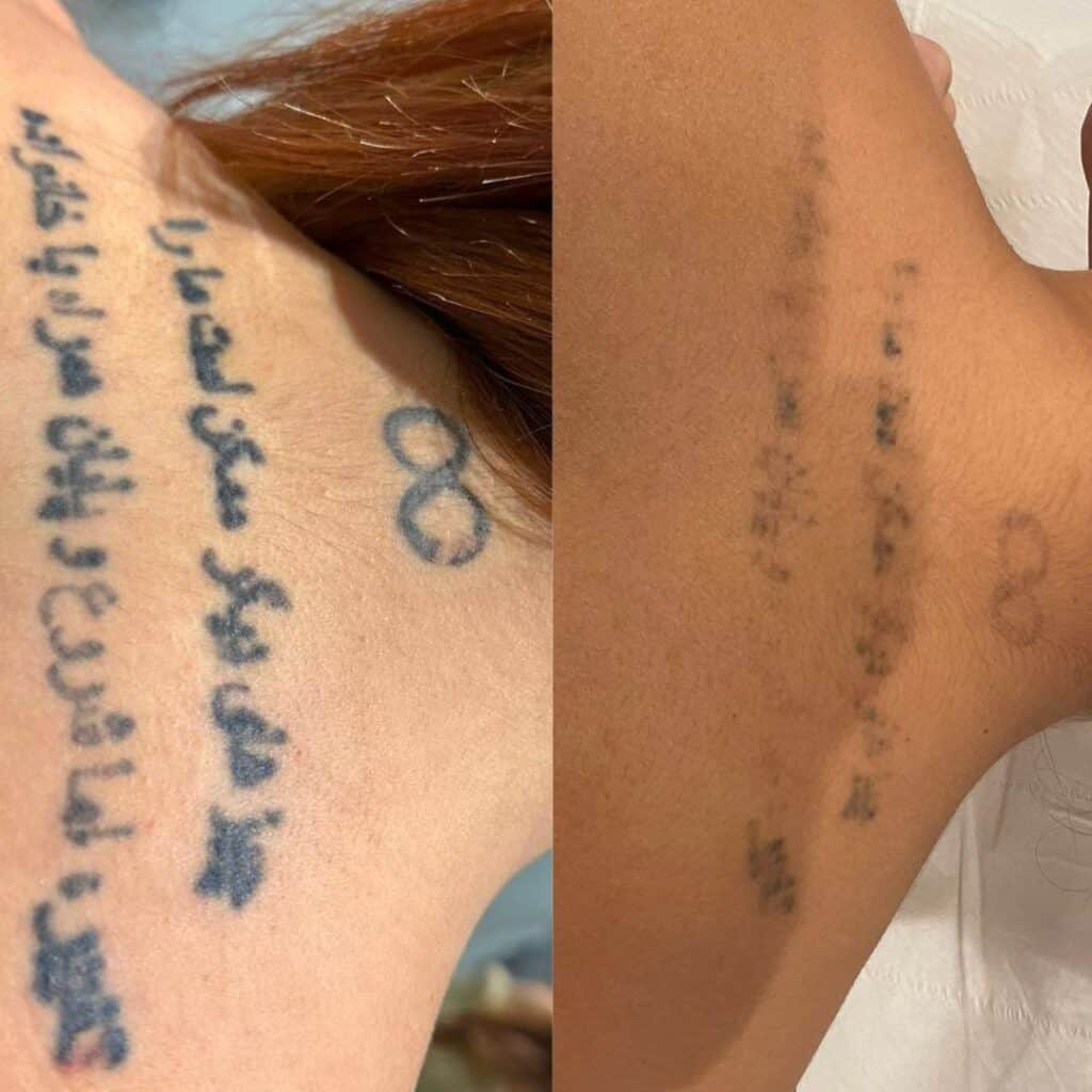 two images are side by side, the first image shows a large black tattoo across the top of the back, the second image shows a large reduction in the appearance of the tattoo
