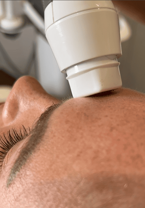 rf microneedling treatment on a forehead