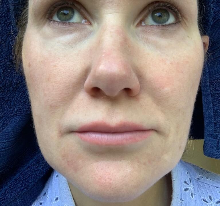 a female face showing clear skin following laser resurfacing