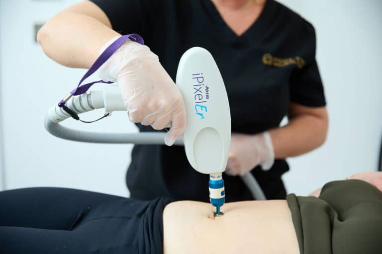An iPixel fractional laser handpiece held to a client's abdomen to treat a scar