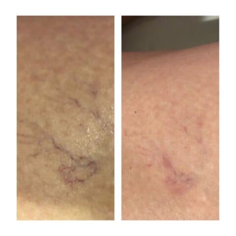 an image showing a spider vein at the top of a leg before and after laser treatment, the vein is a lot less visible after treatment
