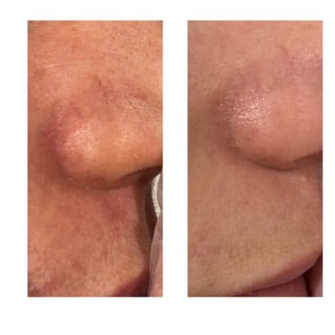 an image showing spider veins around a nose before and after laser treatment, the veins are a lot less visible after treatment