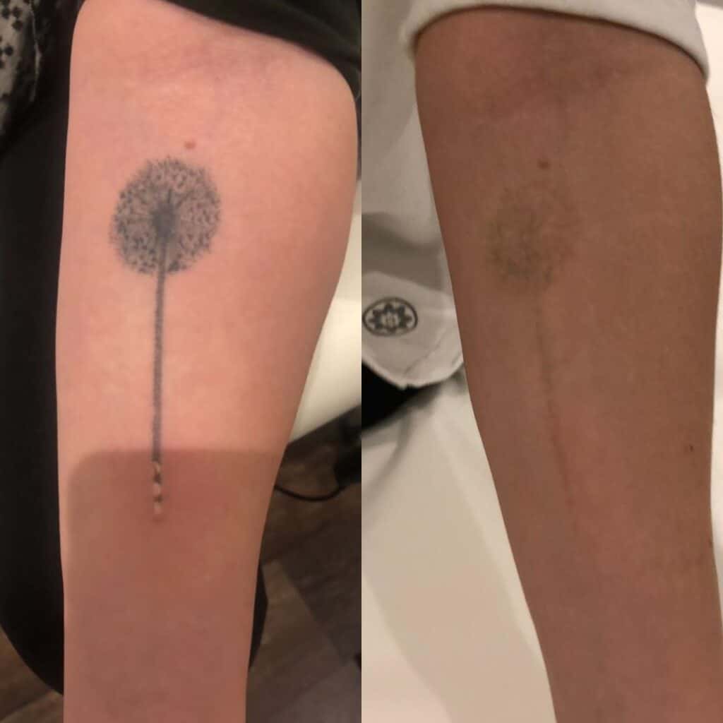 an image of a tattoo on an arm, in the second photo the tattoo is barely visible and appears like a shadow