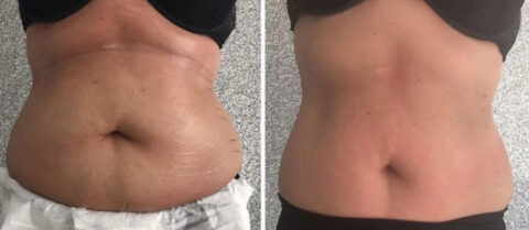lemon bottle fat dissolving on stomach Lemon Bottle Fat Dissolving, Complete Guide to the Treatment