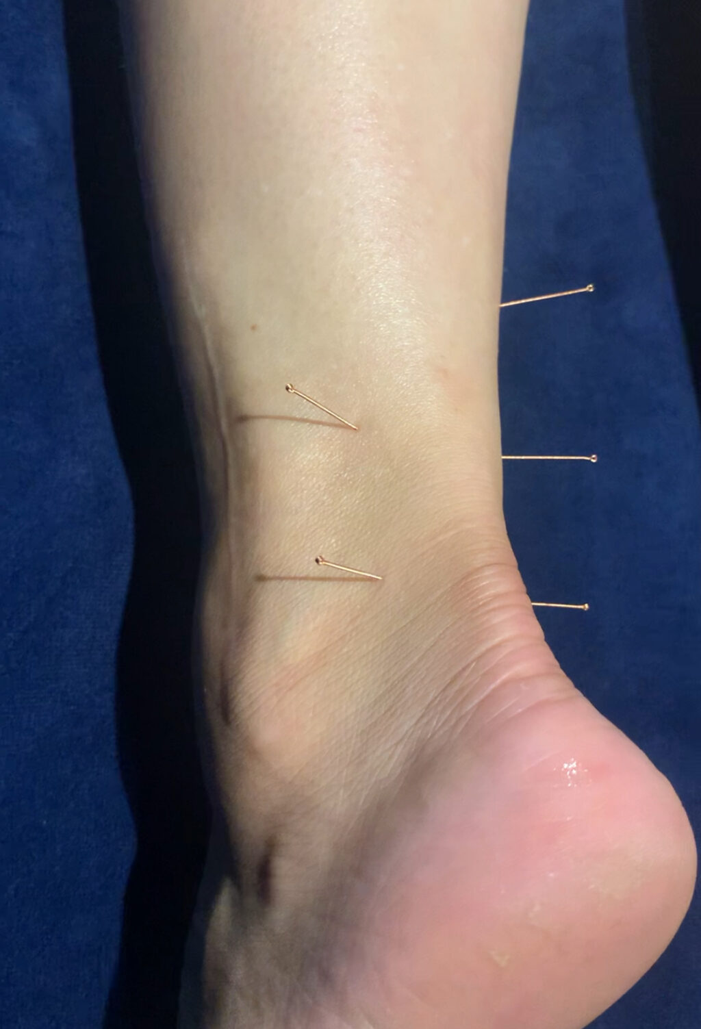 Woman's ankle dry needled