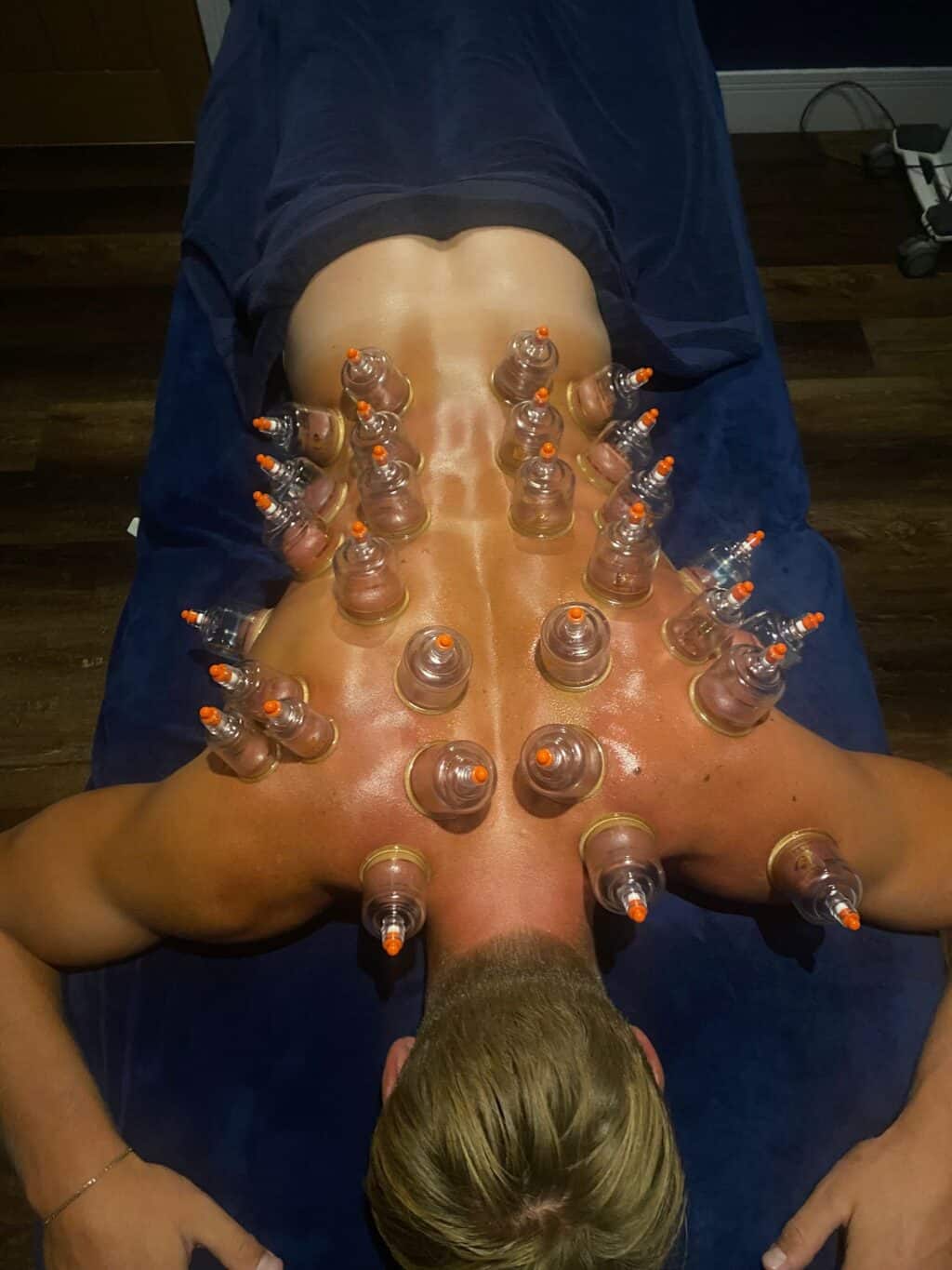 Man having cupping therapy on his back